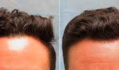 Hair Transplant in Dubai