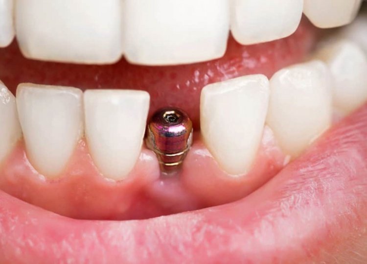 Dental Implants - Types and Benefits