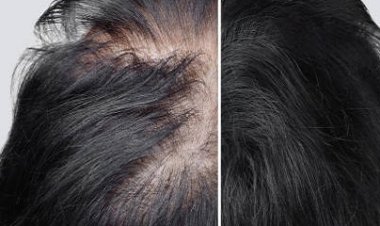 Hair Implant in Dubai & UAE At Royal Clinic ?