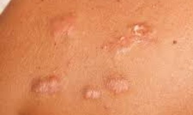 "Dubai's Wellness Revolution: Keloid Treatment for Radiant Skin"