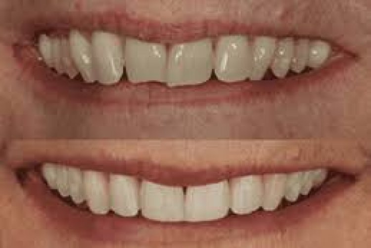 "Dubai's Dental Revolution: Breaking Free from Teeth Grinding Habits"