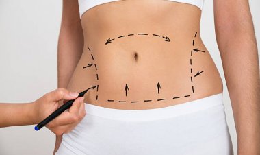 Finding Affordable Abdominal Liposuction in Riyadh