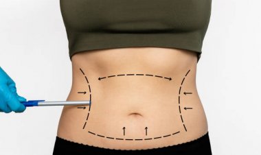 Shape Your Future: Abdominal Liposuction Services in Riyadh