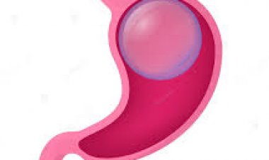 Gastric Balloon Surgery: A Game-Changer for Weight Loss