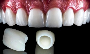 The Ultimate Smile Makeover: Why E-Max Veneers Are the Best