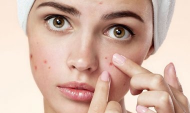 Chemical Peels for Pimples: Riyadh Specialists