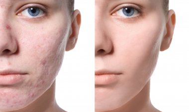 Find Riyadh’s Top Rated Acne Scar Removal Experts