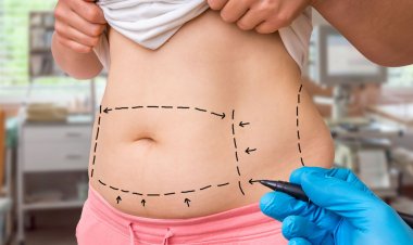 Top Benefits of Liposuction Surgery in Riyadh
