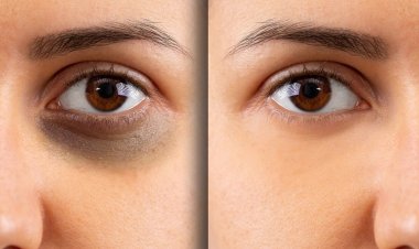 HydraFacial for Dark Circles: Best Providers in Riyadh