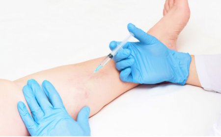 Sclerotherapy for Spider Veins: Clinics in Riyadh
