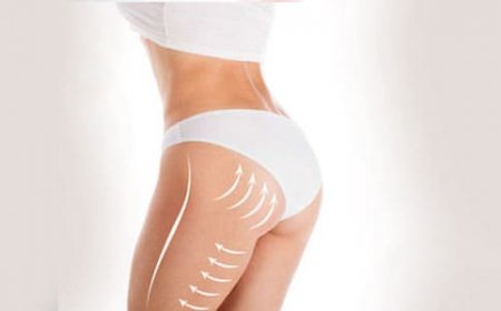 Is a Brazilian Butt Lift Safe? Expert Opinions in Riyadh