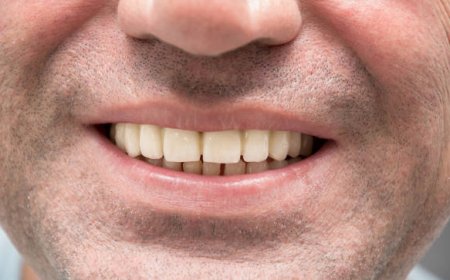 زركونيا كراون في الرياض: الحماية والجمال لأسنانك