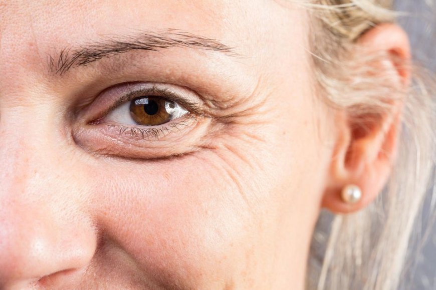 Botox Injections for Wrinkles in Riyadh: What You Need to Know