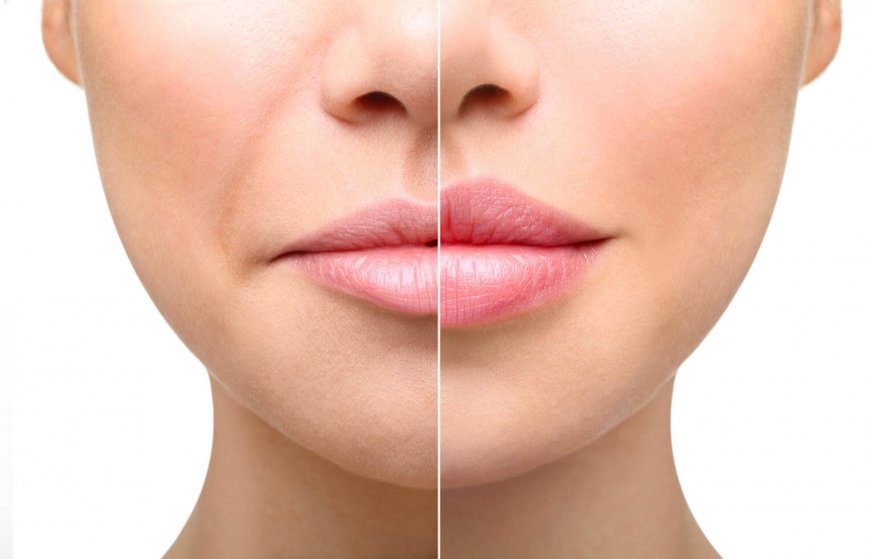 How to Choose the Best Lip Augmentation Specialist in Riyadh