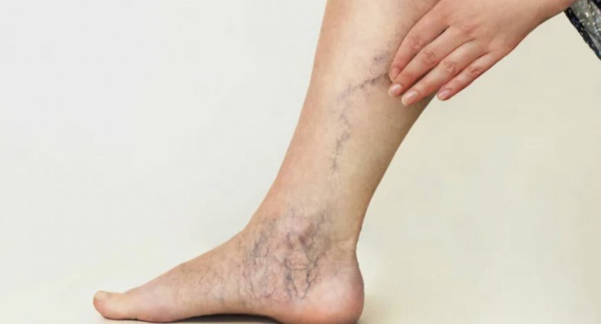 Get Smooth, Clear Legs with Spider Vein Removal in Riyadh