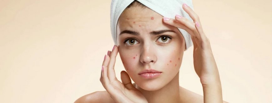 Quick Relief for Pimples: Riyadh Clinics Guide
