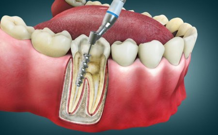 Root Canal Treatment: A Lifesaver for Damaged Teeth