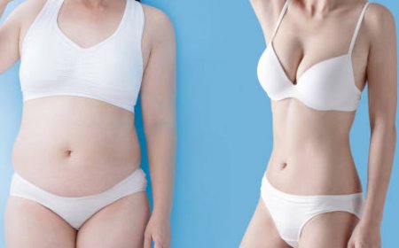 Who’s a Good Candidate for Tummy Tuck in Riyadh?