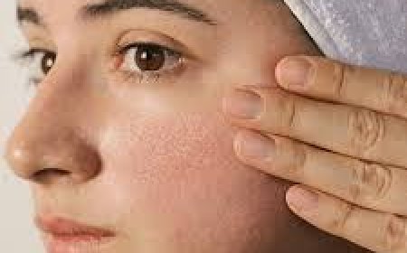 Effective Treatments for Large Pores in Islamabad: Achieving Smooth and Radiant Skin