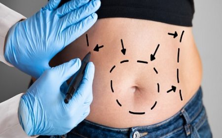 Types of Liposuction Procedures Available in Islamabad