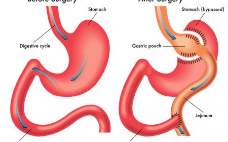Best Doctors for Gastric Sleeve Surgery in Riyadh