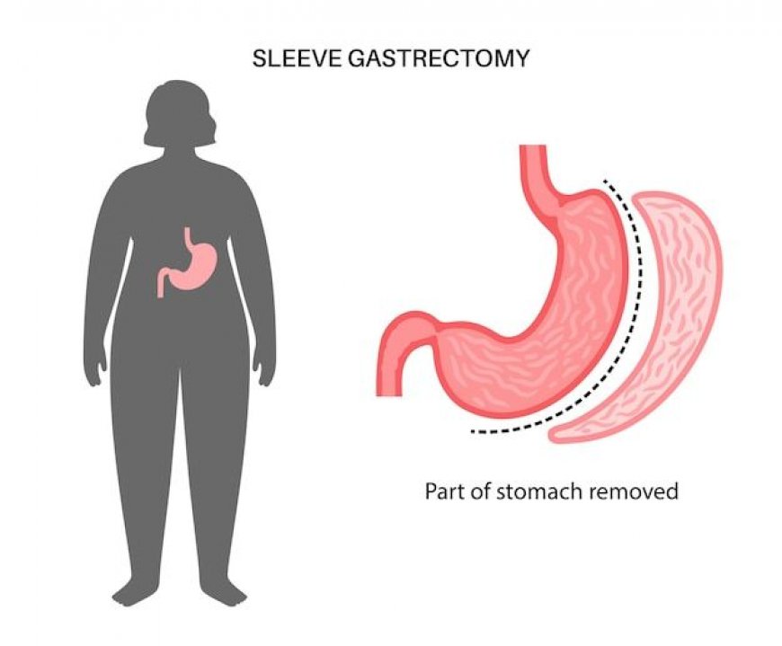 Best Doctors for Gastric Sleeve Surgery in Riyadh – Book Now!