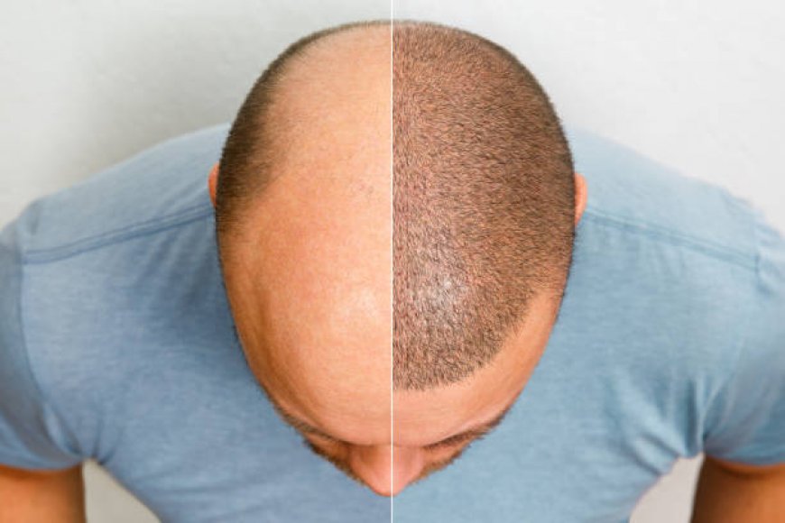 ما هي أفضل تقنية لـ زراعة الشعر في الرياض؟