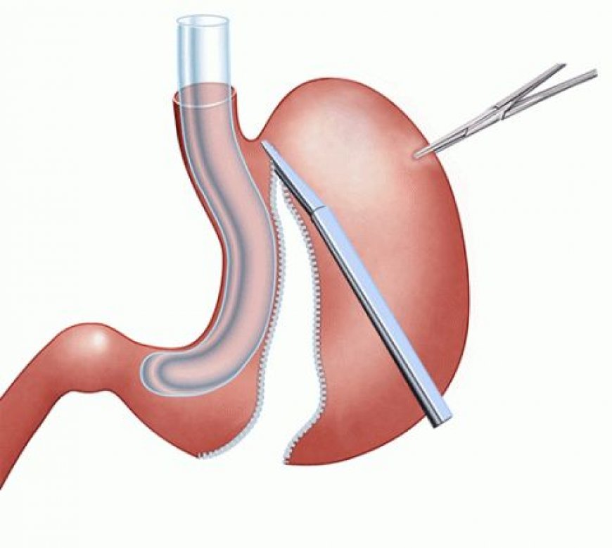 نتائج مذهلة لعملية التكميم في الرياض