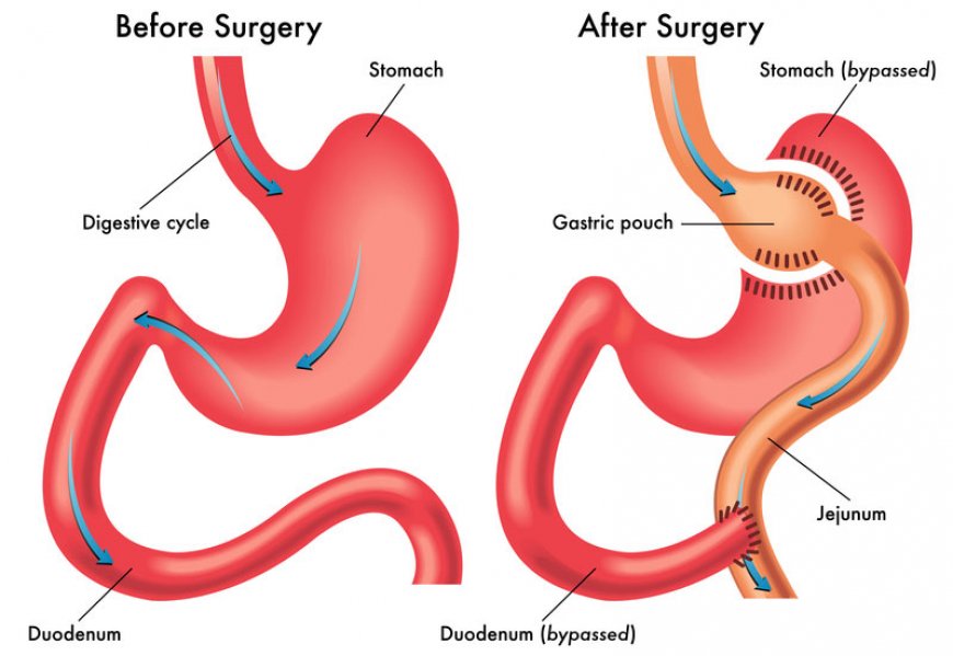 Best Doctors for Gastric Sleeve Surgery in Riyadh