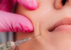 Smooth Smile Lines with Dermal Fillers at Stellar Health and Skin
