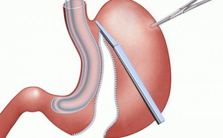 أبرز الأسئلة حول تكميم المعدة بالرياض