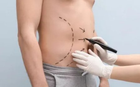Best Liposuction Surgery in Delhi – Reshape Your Confidence