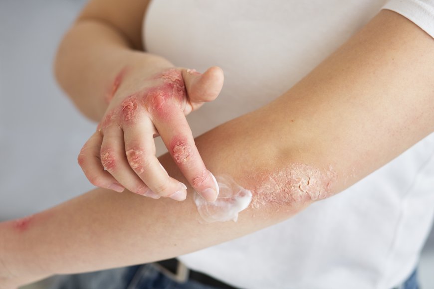 Natural Remedies for Psoriasis: What Works and What Doesn’t?