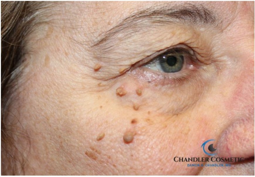 When Can You Wear Makeup Again After Eyelid Surgery?