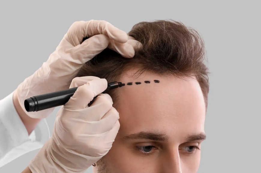 Hair Transplant Costs and Packages in Islamabad
