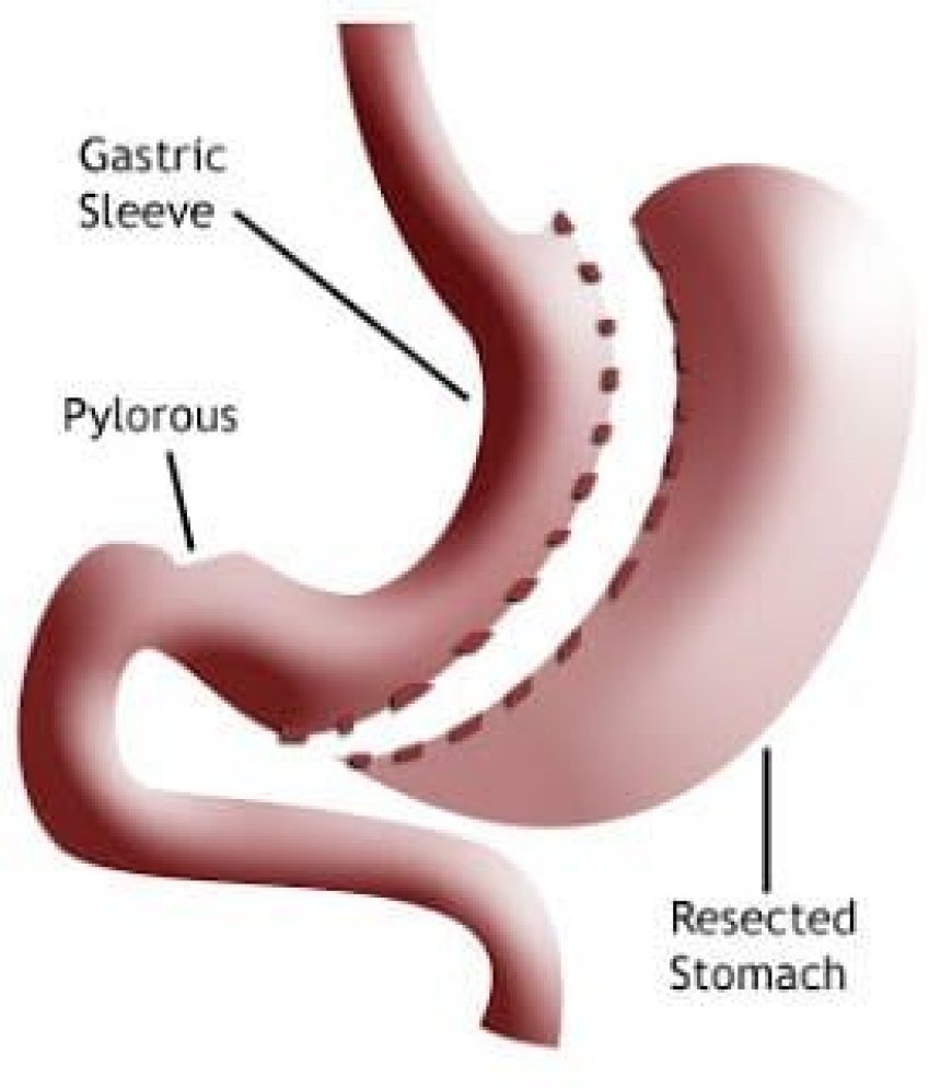 Gastric Sleeve Surgery in Riyadh: Safe and Effective?