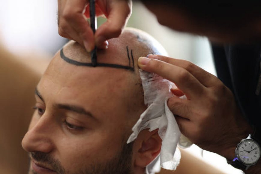 زراعة الشعر في الرياض: هل تناسبك؟ (الدليل الكامل)