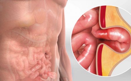 How to Stop a Hernia from Growing?