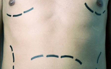 Understanding Gynecomastia Surgery in Riyadh