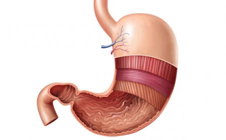 Why Gastric Balloon is Popular for Weight Loss in Riyadh