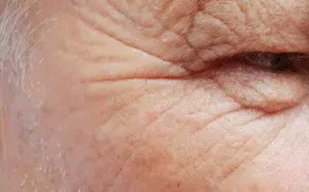 Is Botox Effective for Preventing Future Wrinkles?