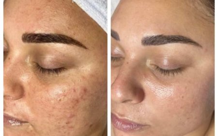 First HydraFacial Session FREE in Peshawar