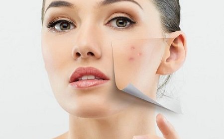 Can Acne Scars Be Fully Removed? Expert Opinions from Islamabad