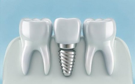 Permanent Fix for Multiple Missing Teeth with Implants