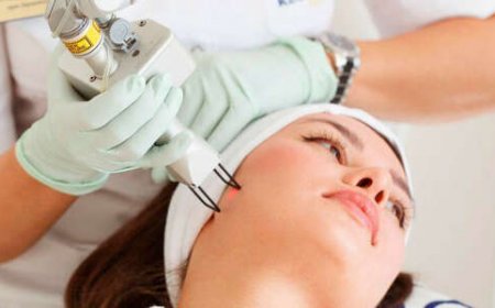 Fractional Laser for Hyperpigmentation