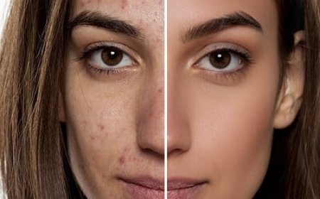 What Causes Acne and How to Prevent It