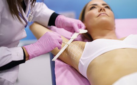 Dealing with Sweaty Underarms in Public? MiraDry Might Be the Fix