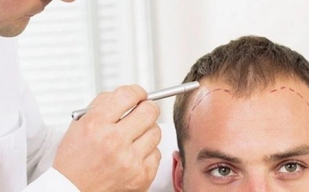Diet and Nutrition for Hair Transplant Success