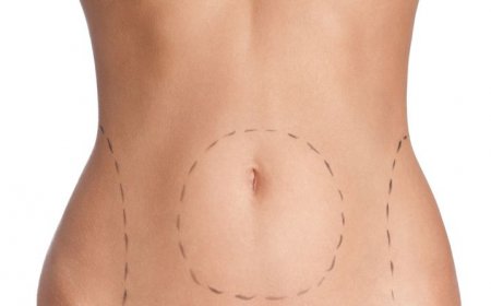 Get Back in Shape with Tummy Tuck in Riyadh
