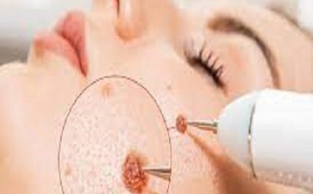 Pain-Free Wart Removal – Fact or Fiction?